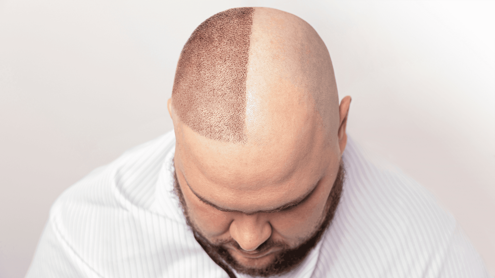 What is Hair Patch? A Complete Guide to Non-Surgical Hair Replacement